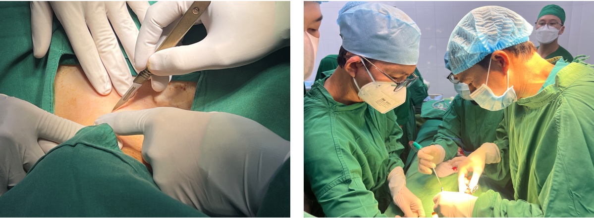 Kinh nghiệm gây mê hồi sức trong phẫu thuật cắt Papilloma thanh khí quản to