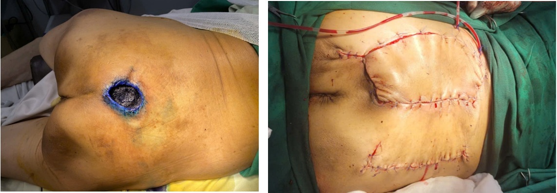 XOAY VẠT DA ĐIỀU TRỊ LOÉT TÌ ĐÈ Ở NGƯỜI CAO TUỔI: KHÔNG CHỈ LÀ PHẪU THUẬT