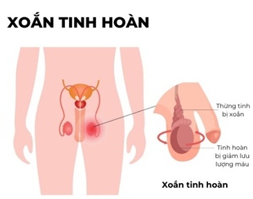 Xoắn tinh hoàn - nhận biết sớm qua một trường hợp được phẫu thuật cấp cứu tại Bệnh viện Trường Đại học Y Dược Cần Thơ