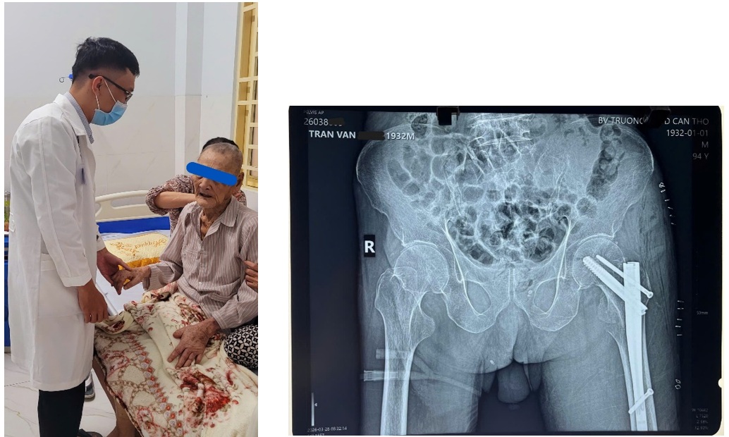 Phẫu thuật thành công cho cụ ông 94 tuổi gãy xương hông có nhiều bệnh nền phức tạp